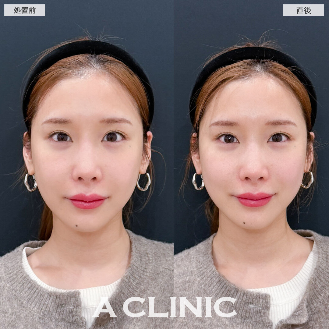 XERF(ザーフ)でチークトップを上げて若々しい印象に！こちら処置前と直後の症例です(30代女性)