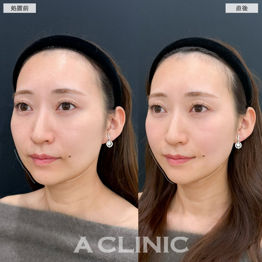 XERF(ザーフ)はお痛み少なくフェイスラインを内側からリフトアップさせます！こちら処置前と直後の症例です(30代女性)