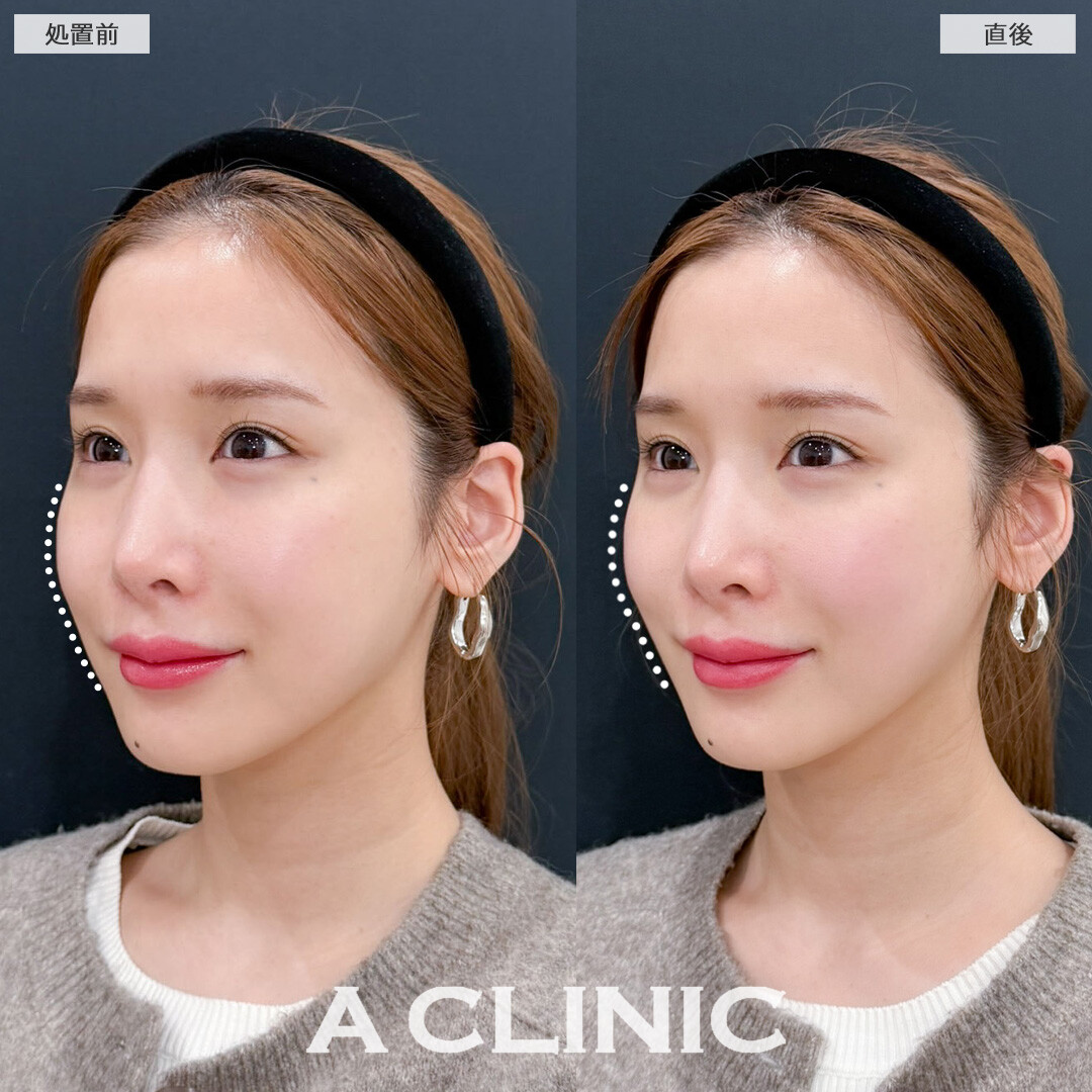 XERF(ザーフ)でチークトップを上げて若々しい印象に！こちら処置前と直後の症例です(30代女性)