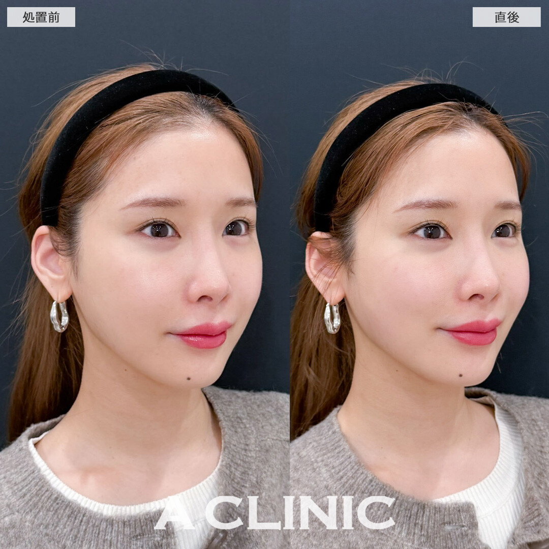 XERF(ザーフ)でチークトップを上げて若々しい印象に！こちら処置前と直後の症例です(30代女性)