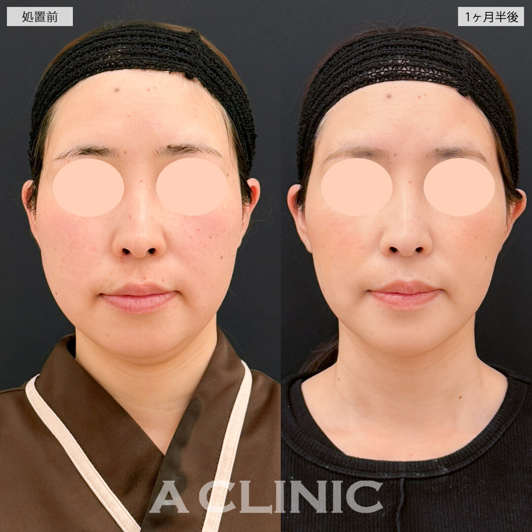 1day小顔脂肪吸引とあごへのヒアルロン酸注入でお顔の歪みが改善！処置前と1ヶ月半後の症例です(30代女性)