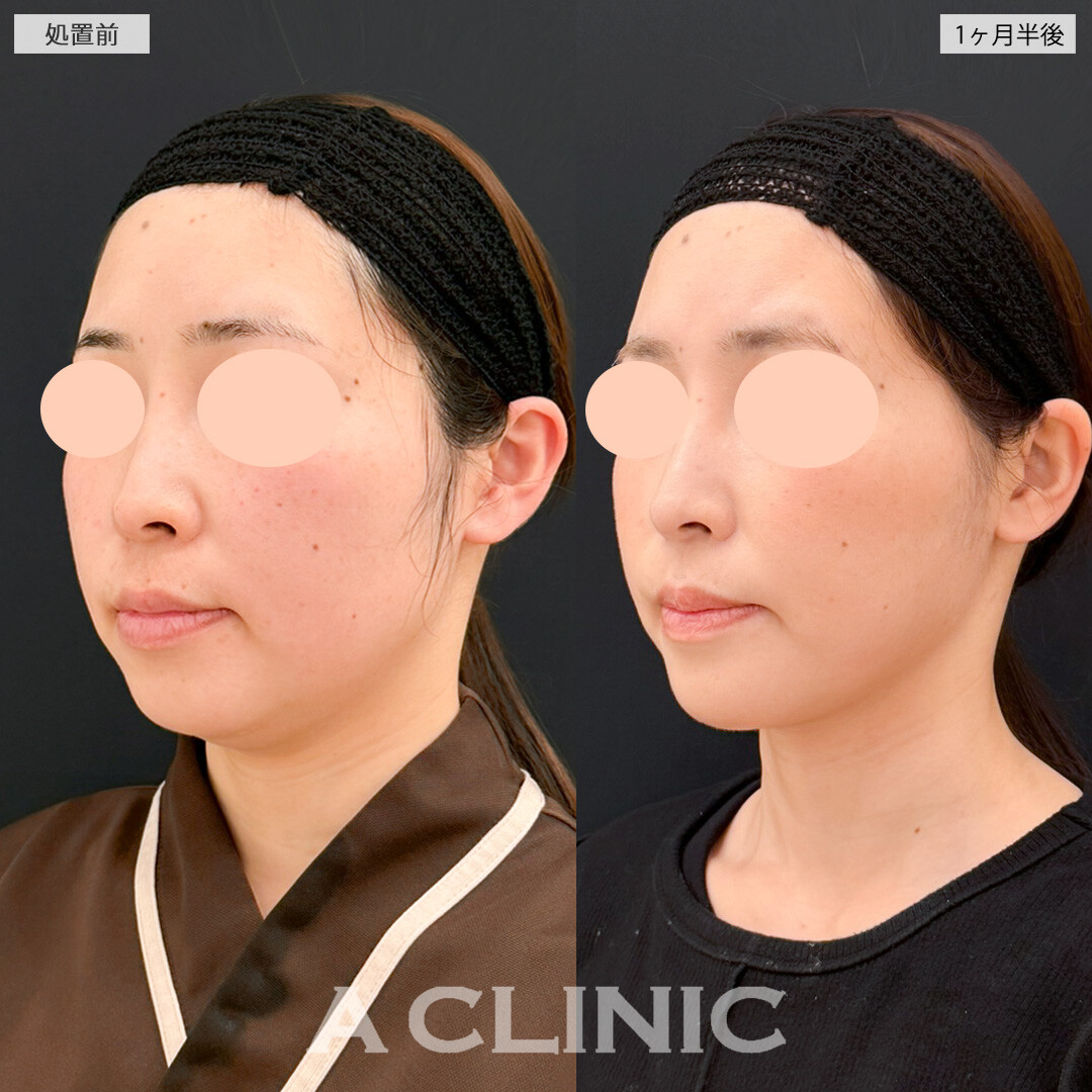 1day小顔脂肪吸引とあごへのヒアルロン酸注入でお顔の歪みが改善！処置前と1ヶ月半後の症例です(30代女性)