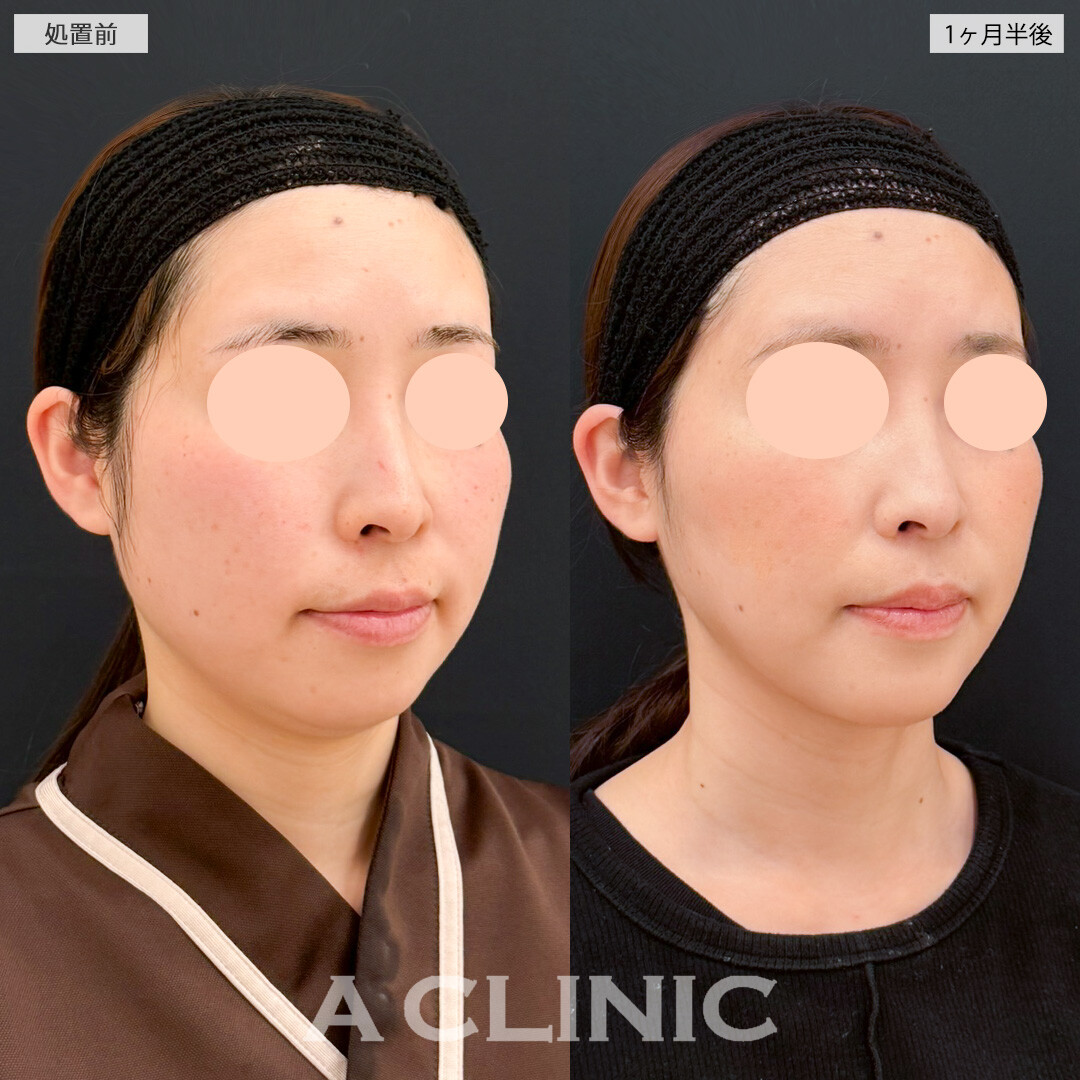 1day小顔脂肪吸引とあごへのヒアルロン酸注入でお顔の歪みが改善！処置前と1ヶ月半後の症例です(30代女性)