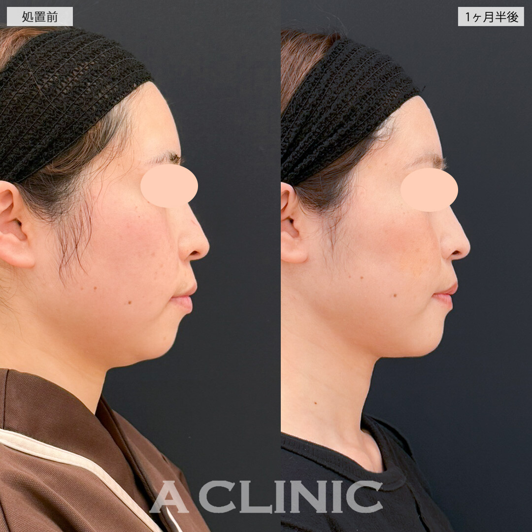 1day小顔脂肪吸引とあごへのヒアルロン酸注入でお顔の歪みが改善！処置前と1ヶ月半後の症例です(30代女性)