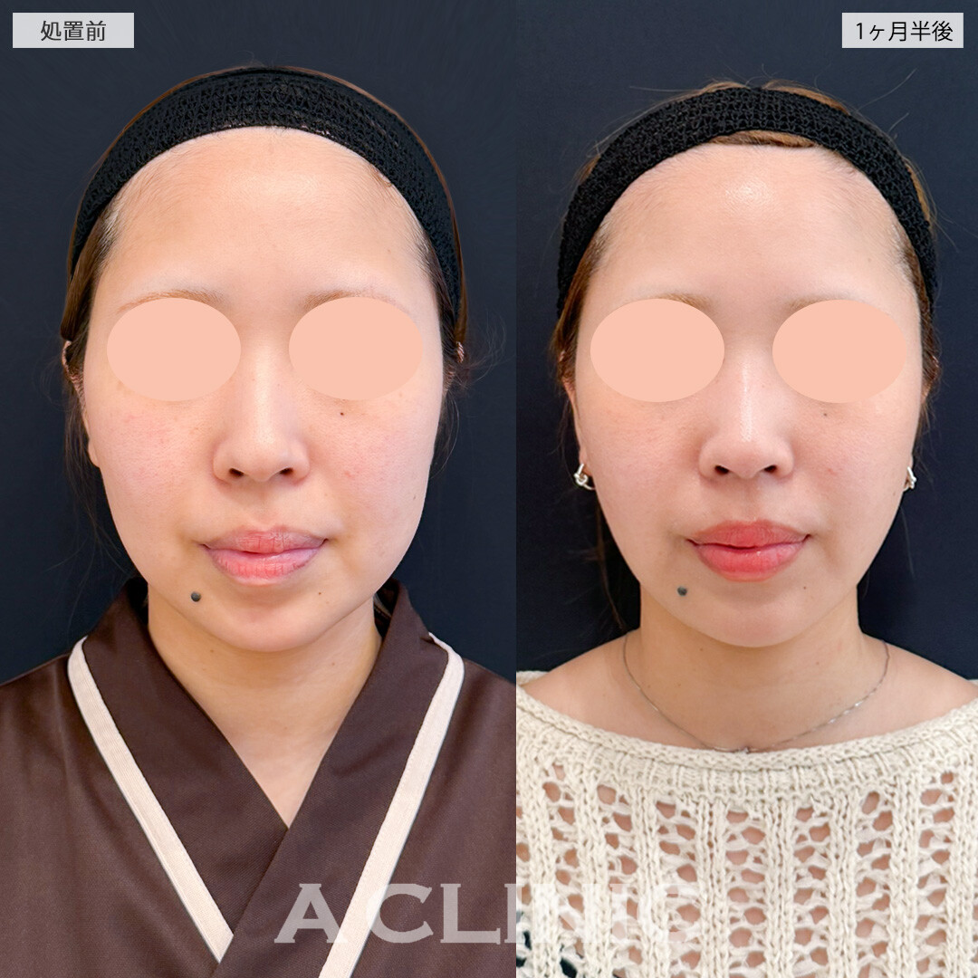 1day小顔脂肪吸引とバッカルファット除去術でピンポイントで不要なお顔の脂肪を撃退！処置前と1ヶ月半後の症例です(20代女性)