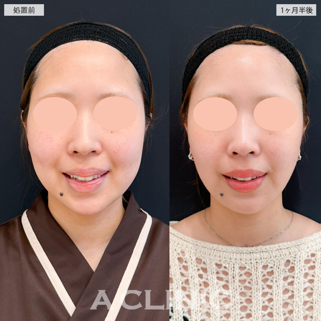 1day小顔脂肪吸引とバッカルファット除去術でピンポイントで不要なお顔の脂肪を撃退！処置前と1ヶ月半後の症例です(20代女性)