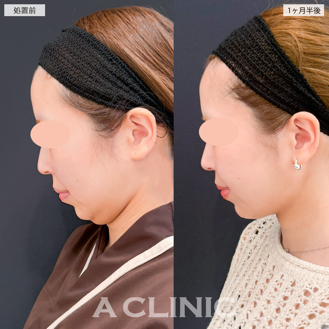 1day小顔脂肪吸引とバッカルファット除去術でピンポイントで不要なお顔の脂肪を撃退！処置前と1ヶ月半後の症例です(20代女性)