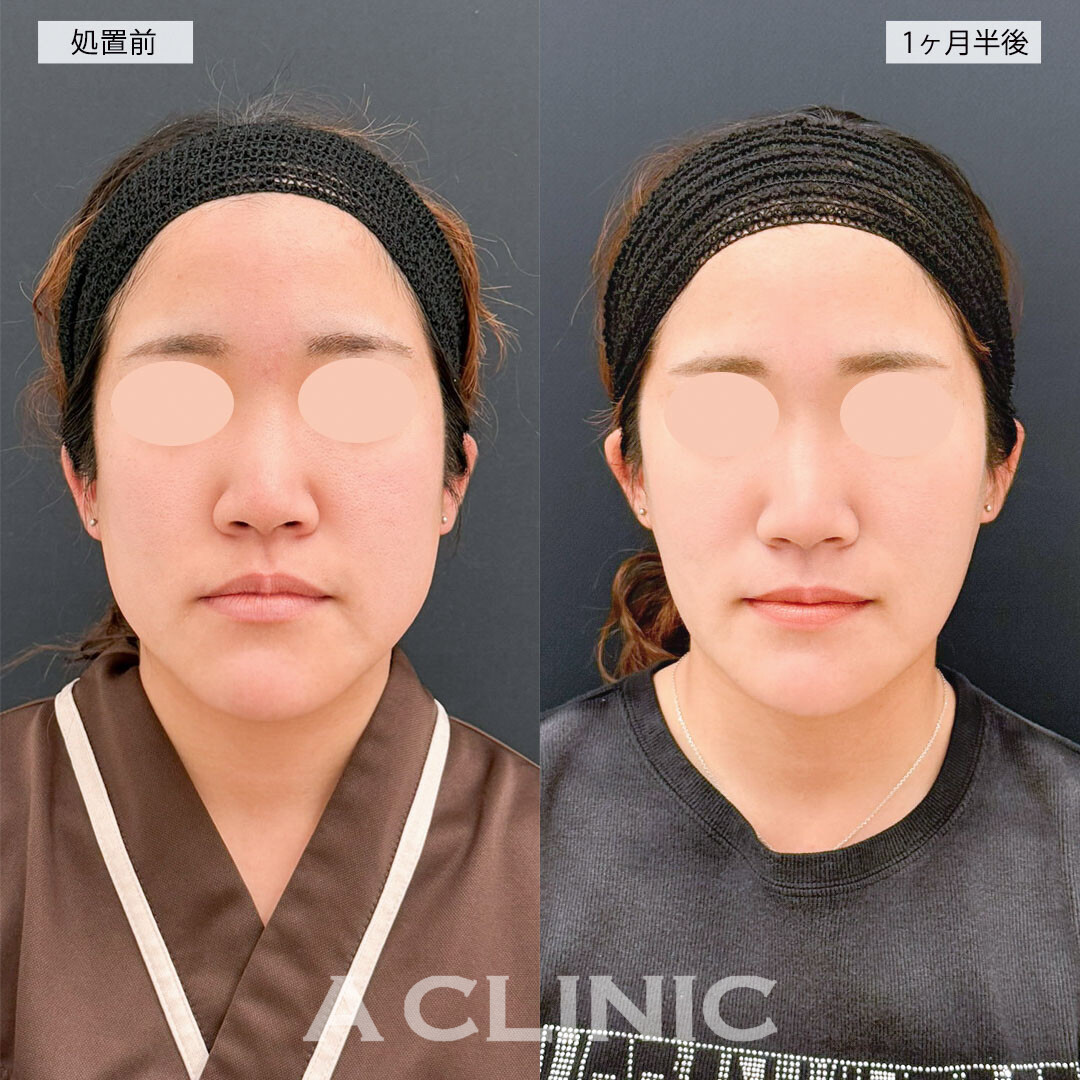 1day小顔脂肪吸引で四角い輪郭が解消されきれいな卵型に！こちら処置前と1ヶ月半後の症例です(20代女性)