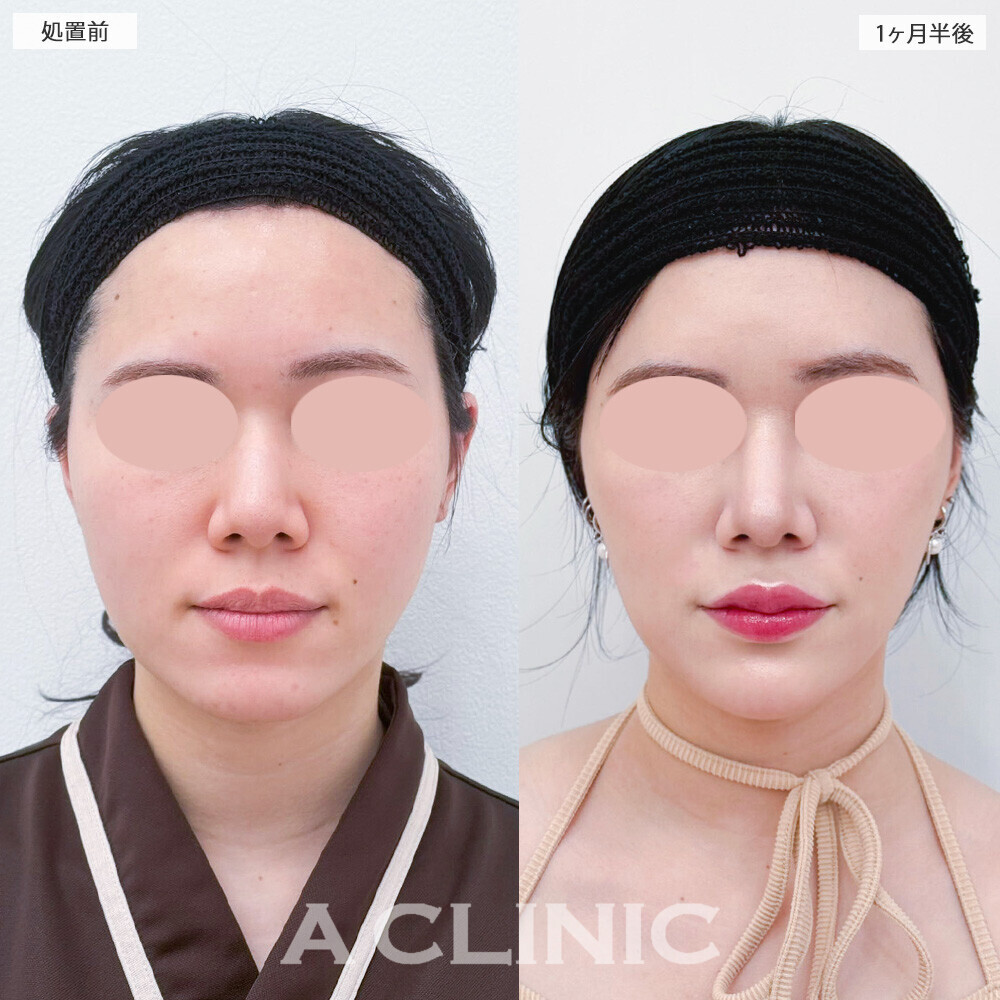 1day小顔脂肪吸引とバッカルファット除去術と小顔エラボトックスで頬のボリューム感一気に改善！こちら処置前と1ヶ月半後の症例です(20代女性)