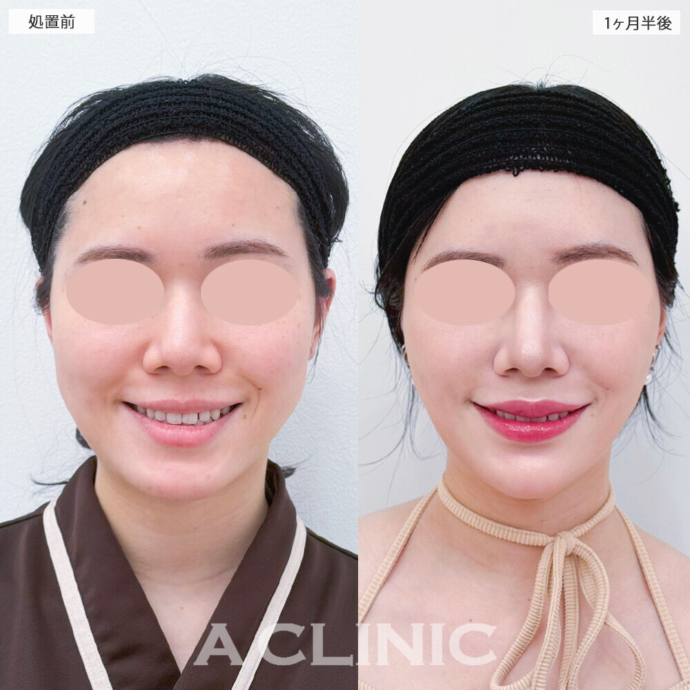 1day小顔脂肪吸引とバッカルファット除去術と小顔エラボトックスで頬のボリューム感一気に改善！こちら処置前と1ヶ月半後の症例です(20代女性)