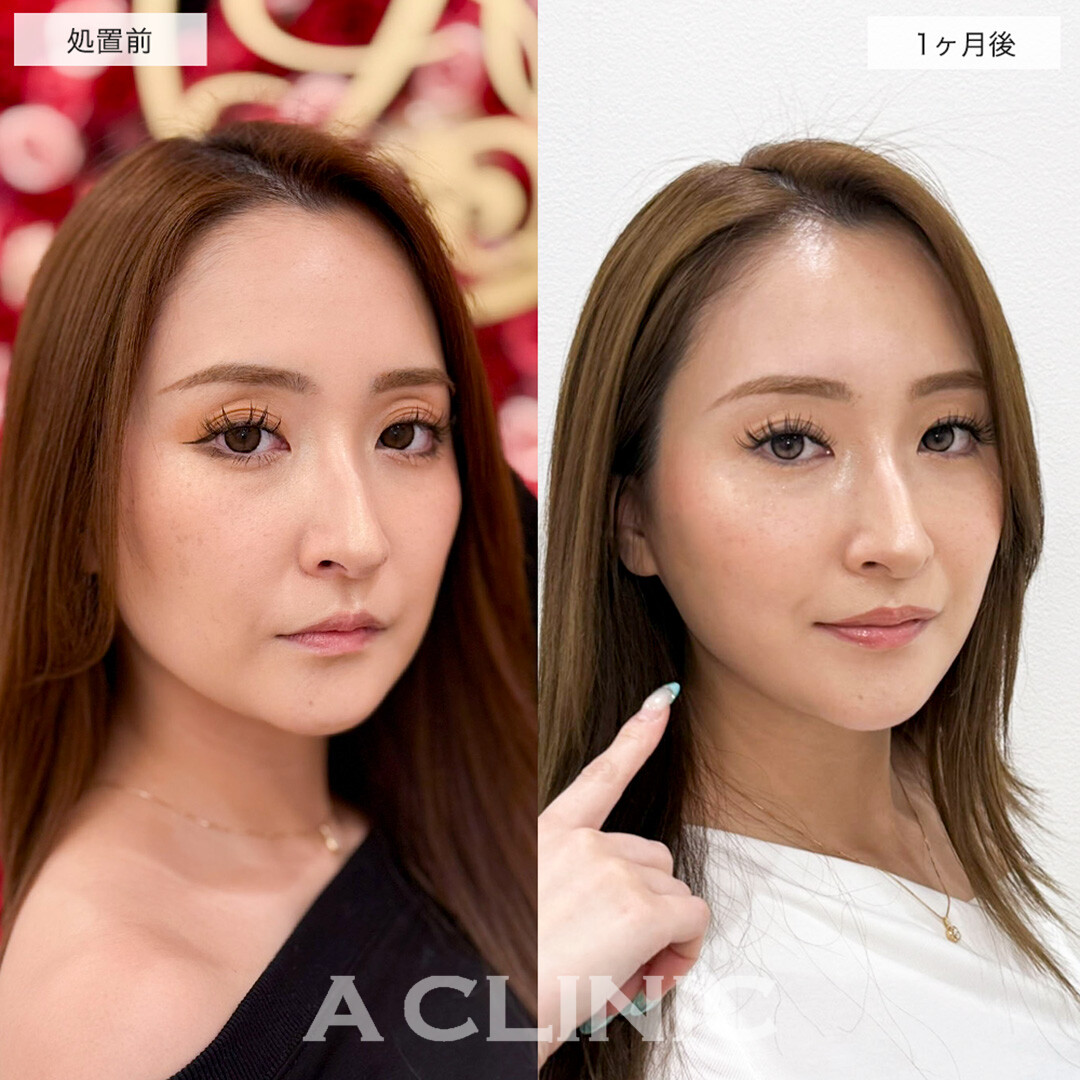 1day小顔脂肪吸引で余分な脂肪を除去しハリのある若々しい輪郭に!こちら処置前と1ヶ月後の症例です(20代女性)