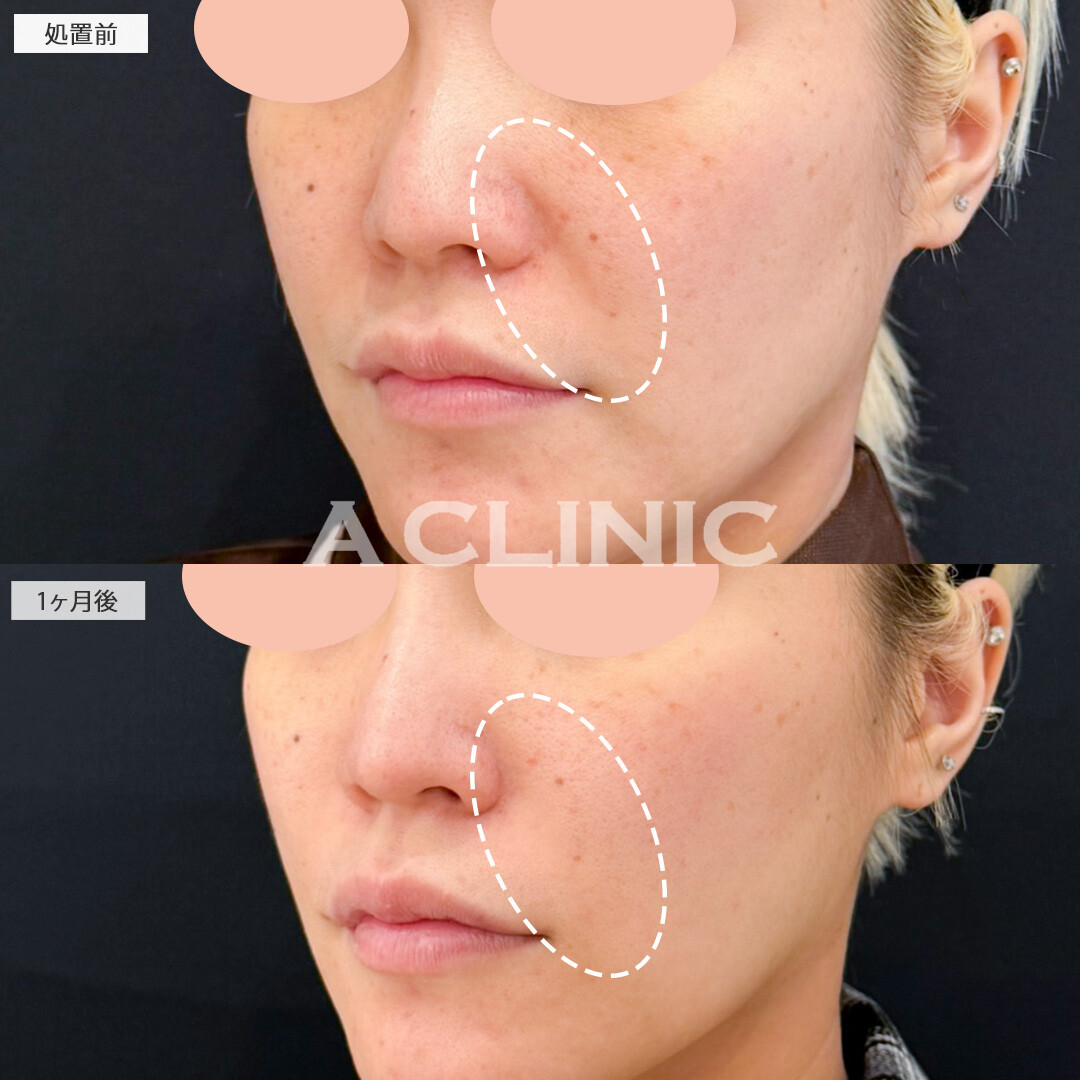 1day小顔脂肪吸引とナゾラビアルファット除去術で脂肪が減りたるみが目立ちにくくなりました！処置前と1ヶ月後の症例です(30代女性)