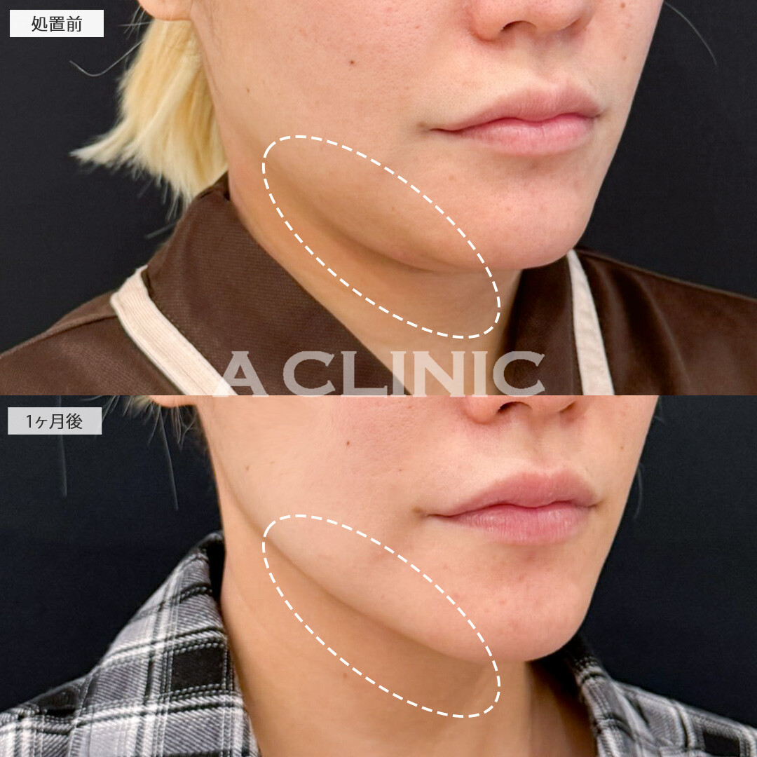 1day小顔脂肪吸引とナゾラビアルファット除去術で脂肪が減りたるみが目立ちにくくなりました！処置前と1ヶ月後の症例です(30代女性)