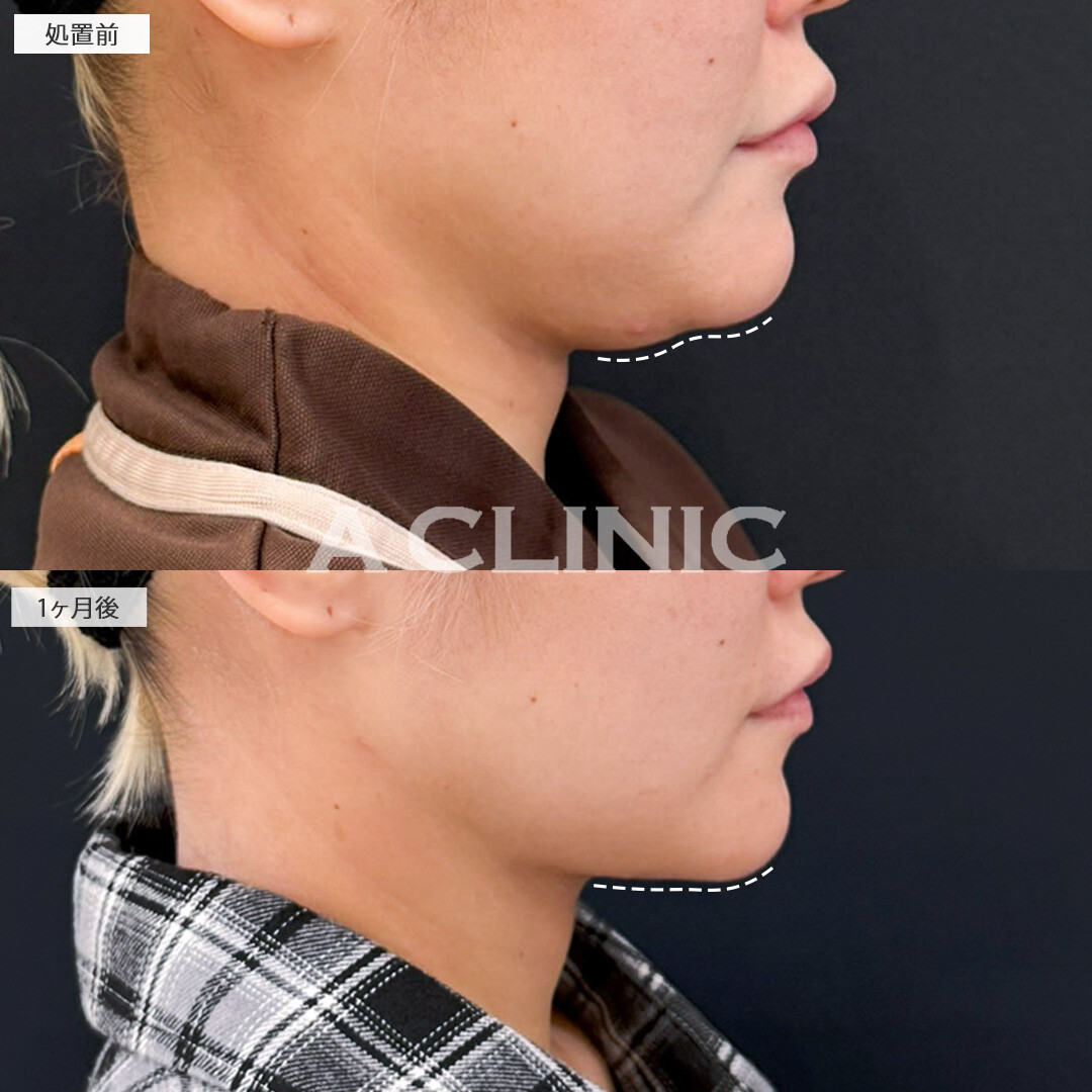 1day小顔脂肪吸引とナゾラビアルファット除去術で脂肪が減りたるみが目立ちにくくなりました！処置前と1ヶ月後の症例です(30代女性)