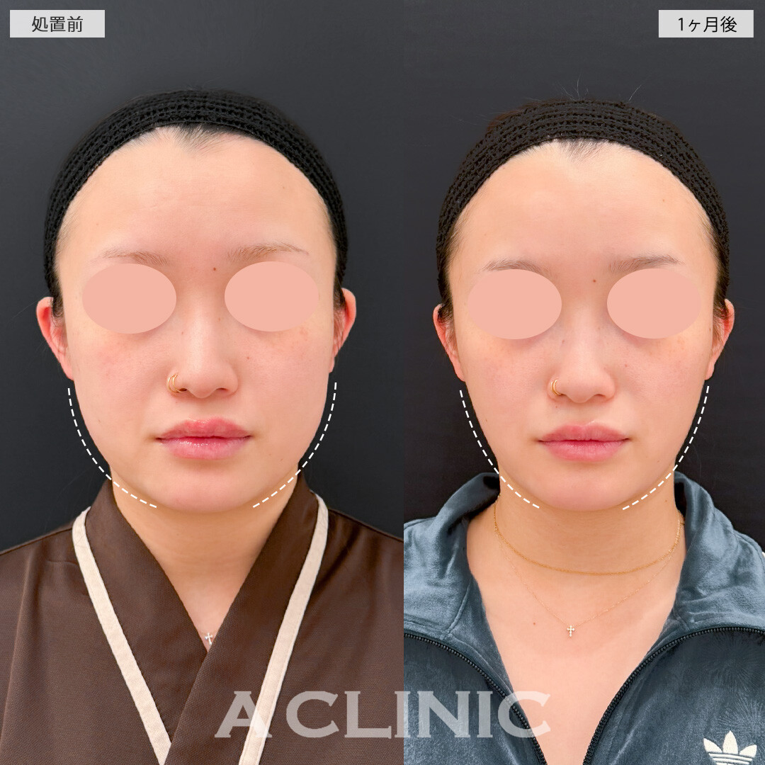 1day小顔脂肪吸引と小顔エラボトックスでフェイスラインがくっきりし首が長く見えるようになりました！処置前と1ヶ月後の症例です(20代女性)