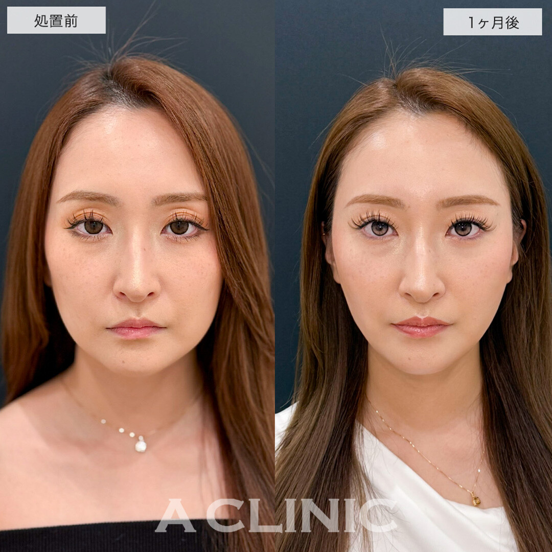 1day小顔脂肪吸引で余分な脂肪を除去しハリのある若々しい輪郭に!こちら処置前と1ヶ月後の症例です(20代女性)