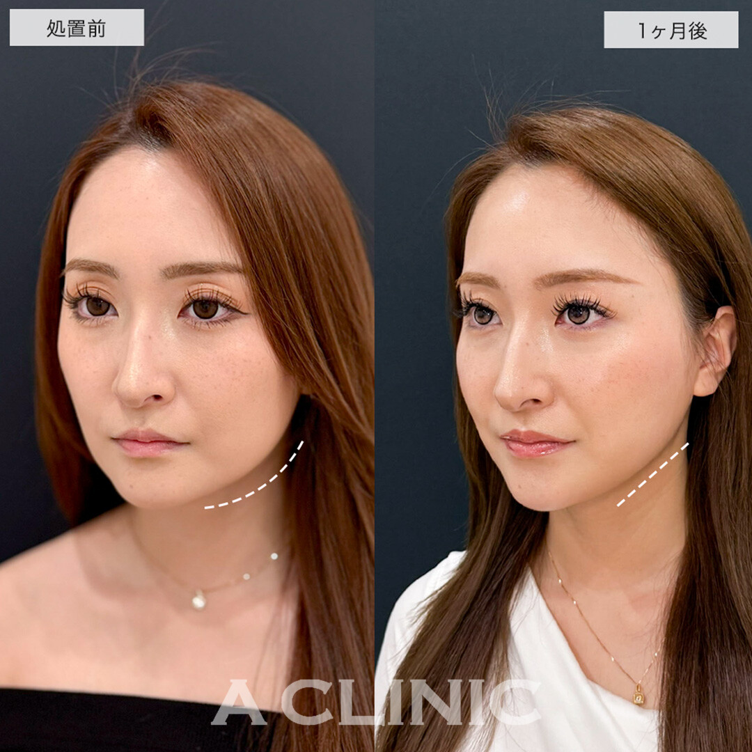 1day小顔脂肪吸引で余分な脂肪を除去しハリのある若々しい輪郭に!こちら処置前と1ヶ月後の症例です(20代女性)