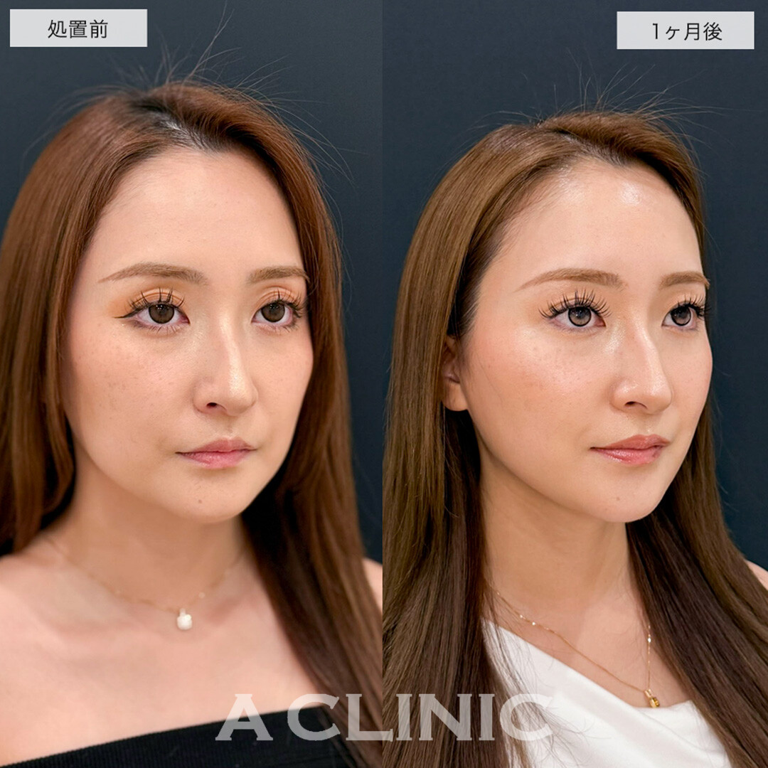 1day小顔脂肪吸引で余分な脂肪を除去しハリのある若々しい輪郭に!こちら処置前と1ヶ月後の症例です(20代女性)