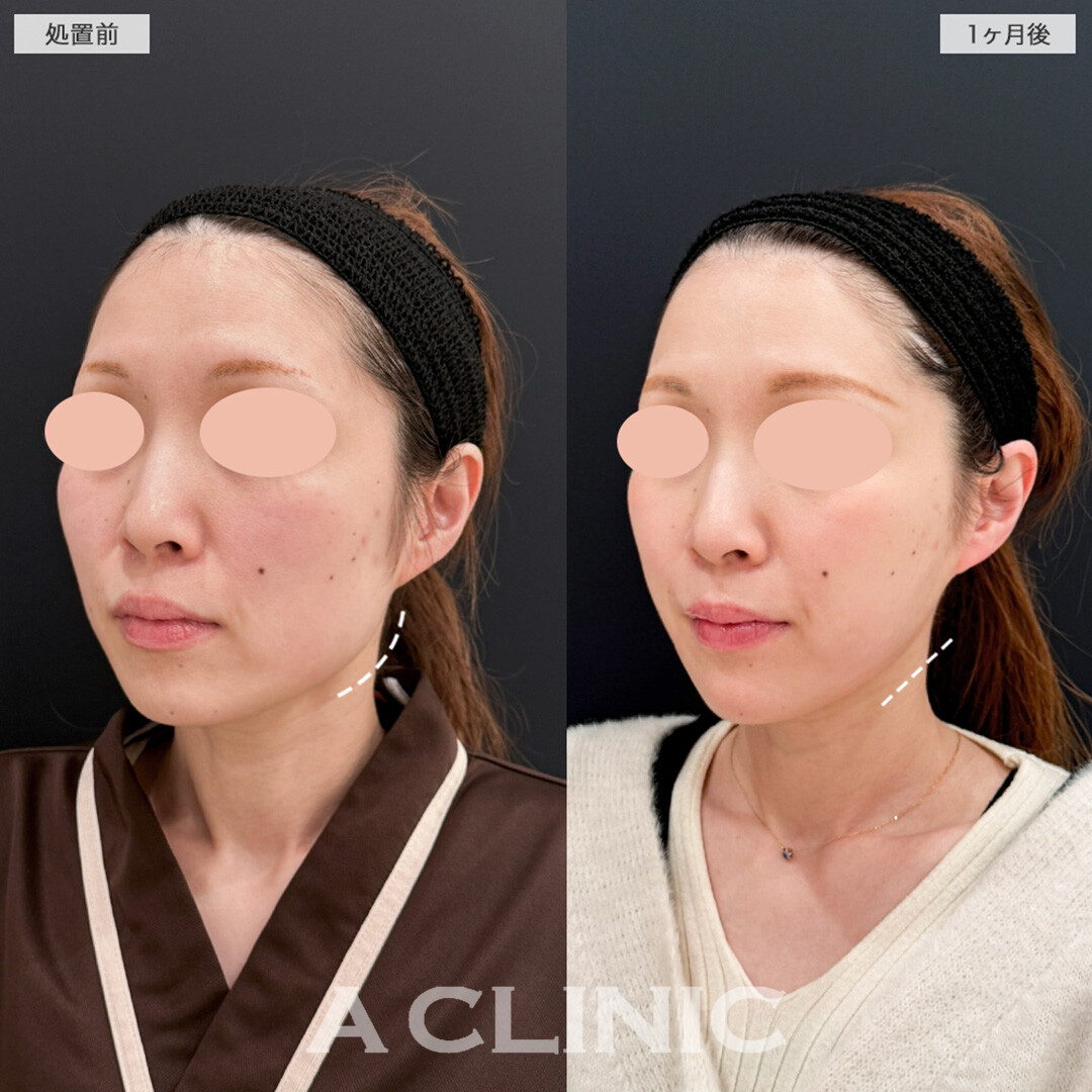 1day小顔脂肪吸引と小顔エラボトックスで洗礼された卵型輪郭へ！処置前と1ヶ月後の症例です(30代女性)