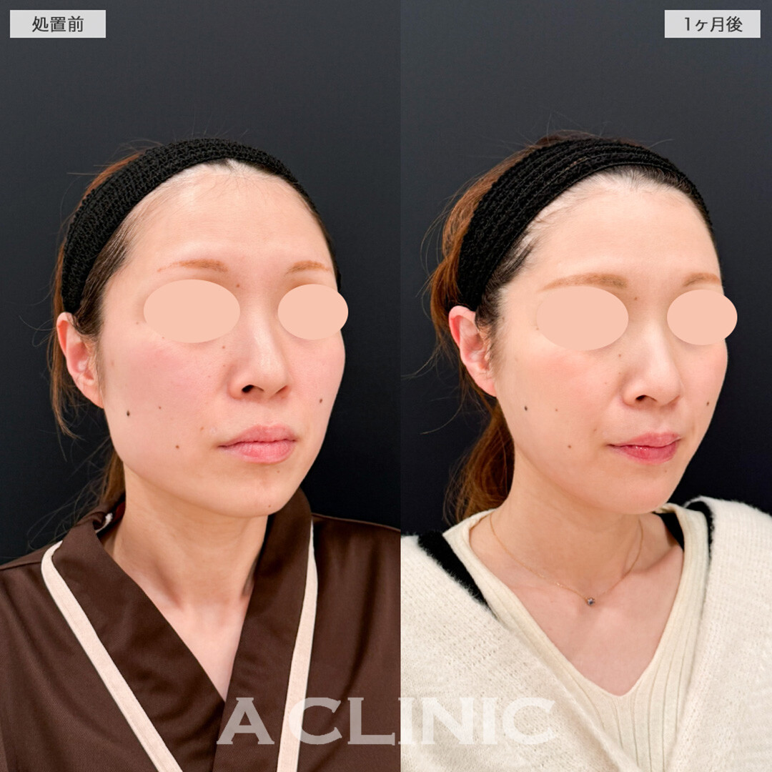 1day小顔脂肪吸引と小顔エラボトックスで洗礼された卵型輪郭へ！処置前と1ヶ月後の症例です(30代女性)