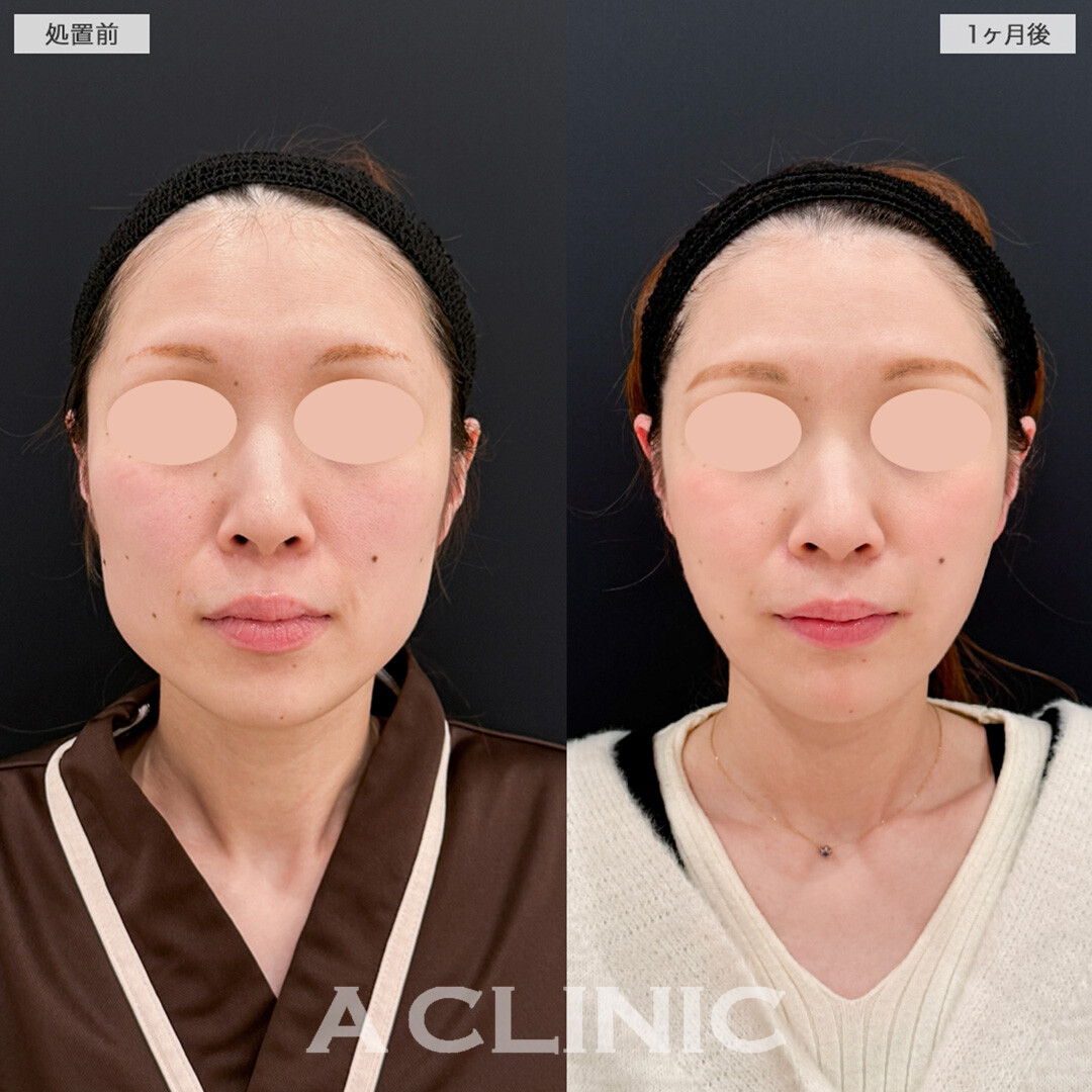 1day小顔脂肪吸引と小顔エラボトックスで洗礼された卵型輪郭へ！処置前と1ヶ月後の症例です(30代女性)