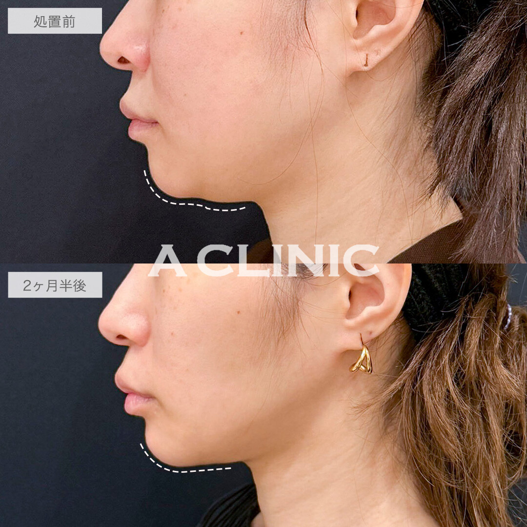 1day小顔脂肪吸引とバッカルファット除去術でどこから見ても洗練された輪郭に！処置前と2ヶ月半後の症例です(30代女性)