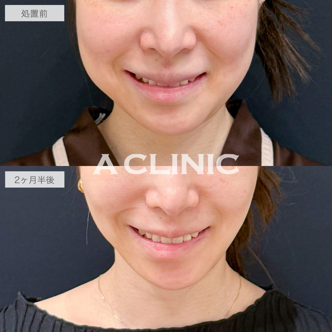 1day小顔脂肪吸引とバッカルファット除去術でどこから見ても洗練された輪郭に！処置前と2ヶ月半後の症例です(30代女性)