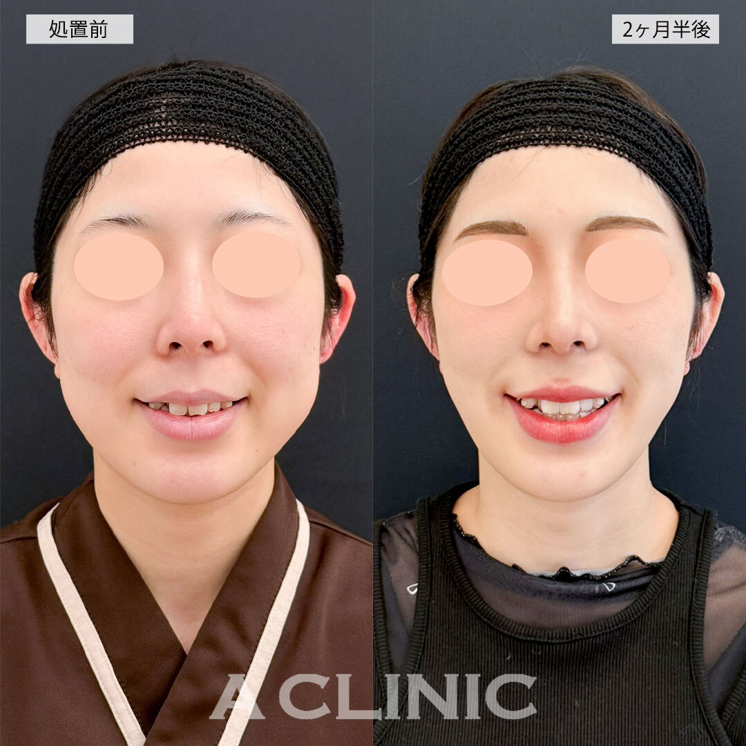 1day小顔脂肪吸引とバッカルファット除去術で笑った時の頬の張りが改善され素敵な笑顔に！こちら処置前と2ヶ月半後の症例です(20代女性)