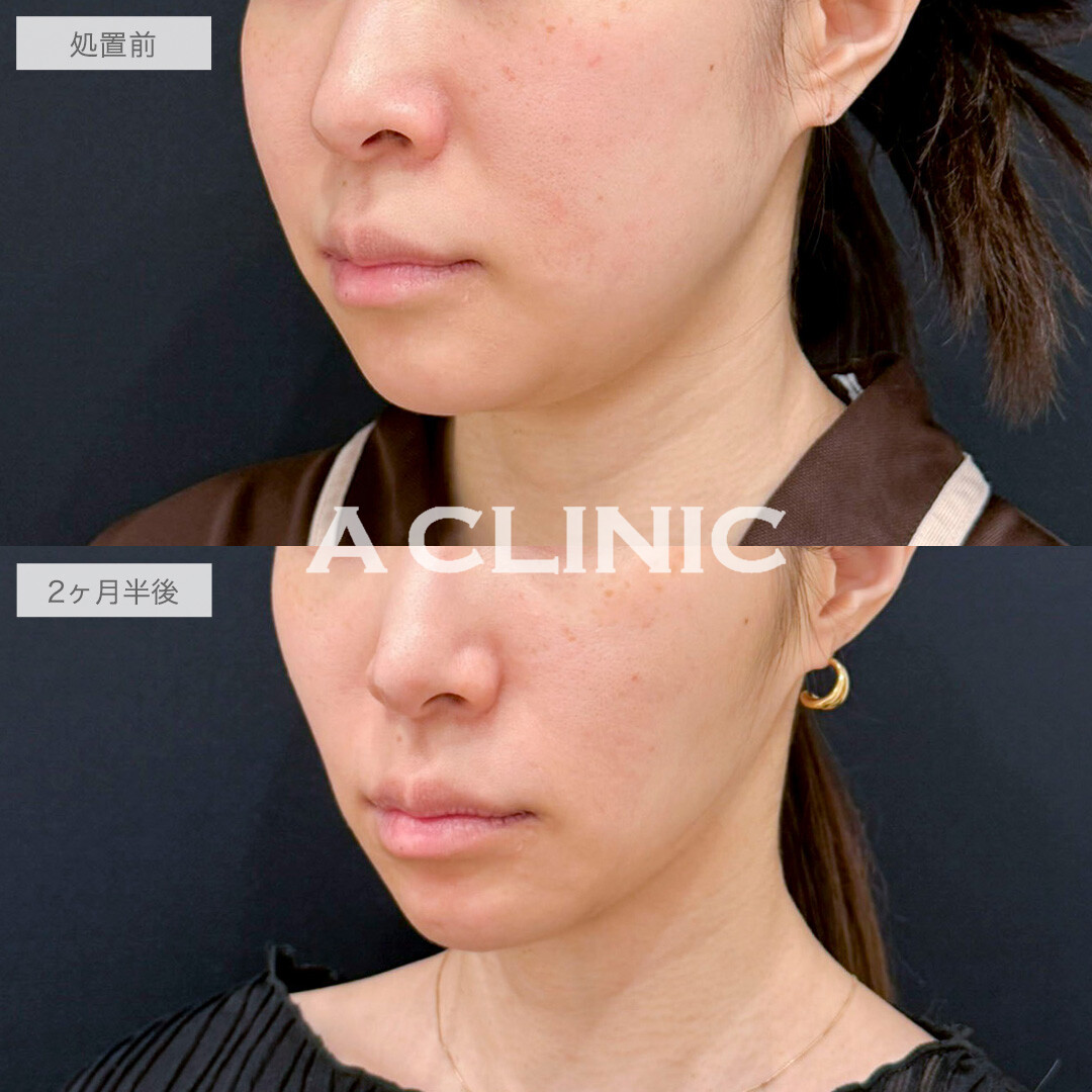 1day小顔脂肪吸引とバッカルファット除去術でどこから見ても洗練された輪郭に！処置前と2ヶ月半後の症例です(30代女性)
