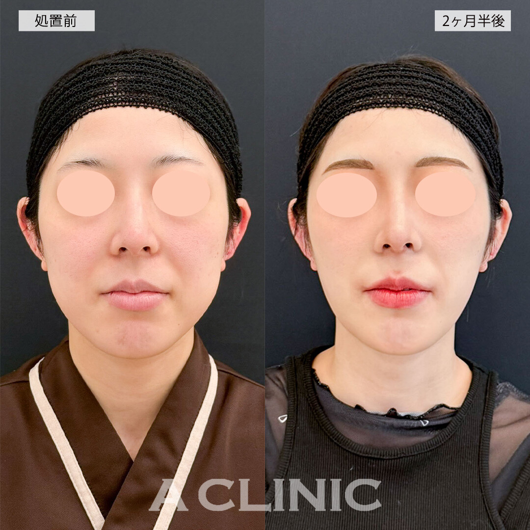 1day小顔脂肪吸引とバッカルファット除去術で笑った時の頬の張りが改善され素敵な笑顔に！こちら処置前と2ヶ月半後の症例です(20代女性)