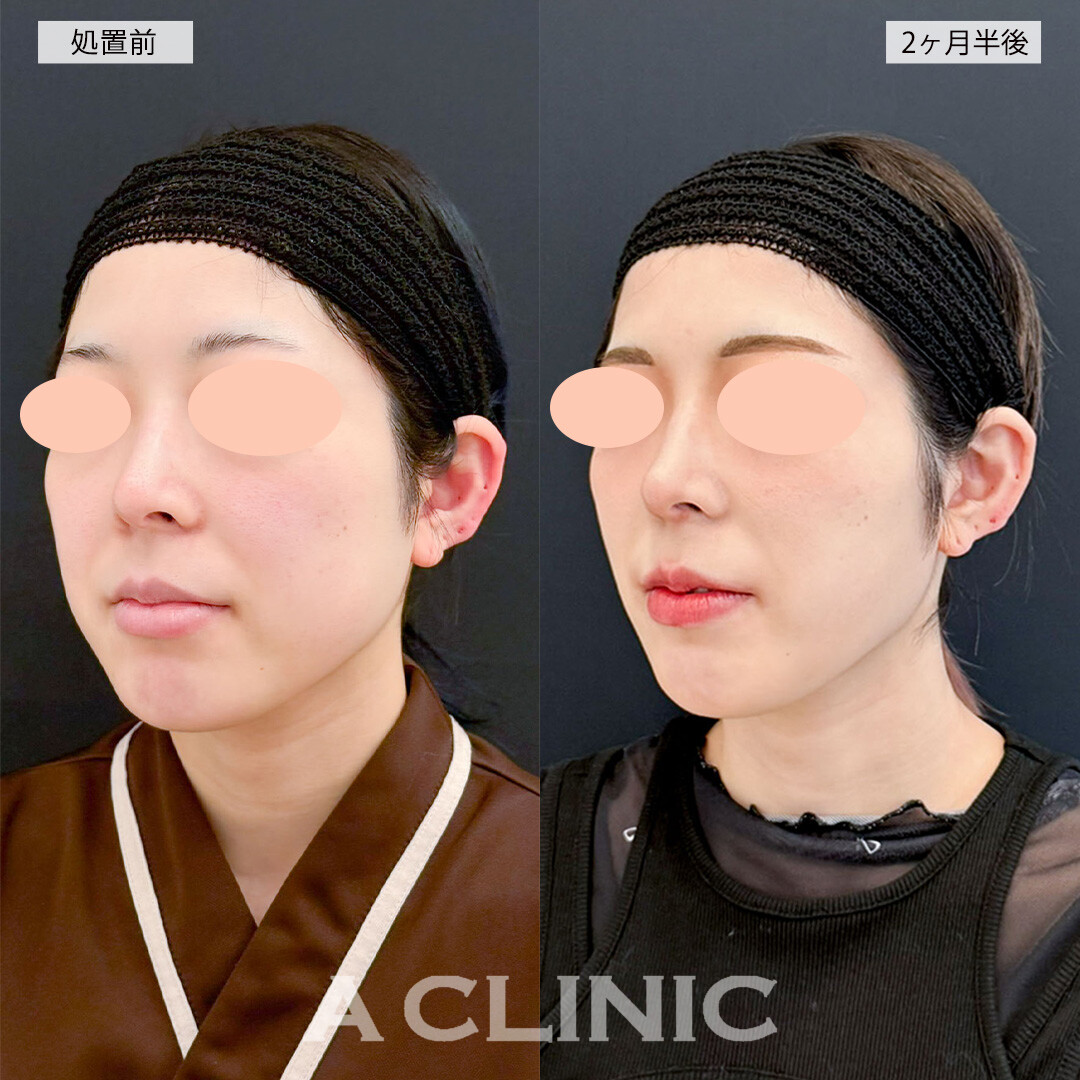 1day小顔脂肪吸引とバッカルファット除去術で笑った時の頬の張りが改善され素敵な笑顔に！こちら処置前と2ヶ月半後の症例です(20代女性)