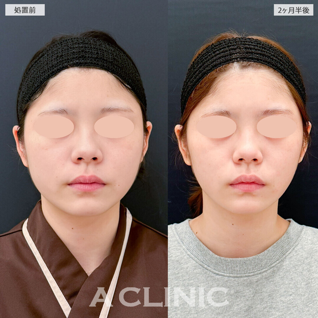 1day小顔脂肪吸引と小顔エラボトックスで整形感なく自然に垢抜け！こちら処置前と2ヶ月半後の症例です(20代女性)
