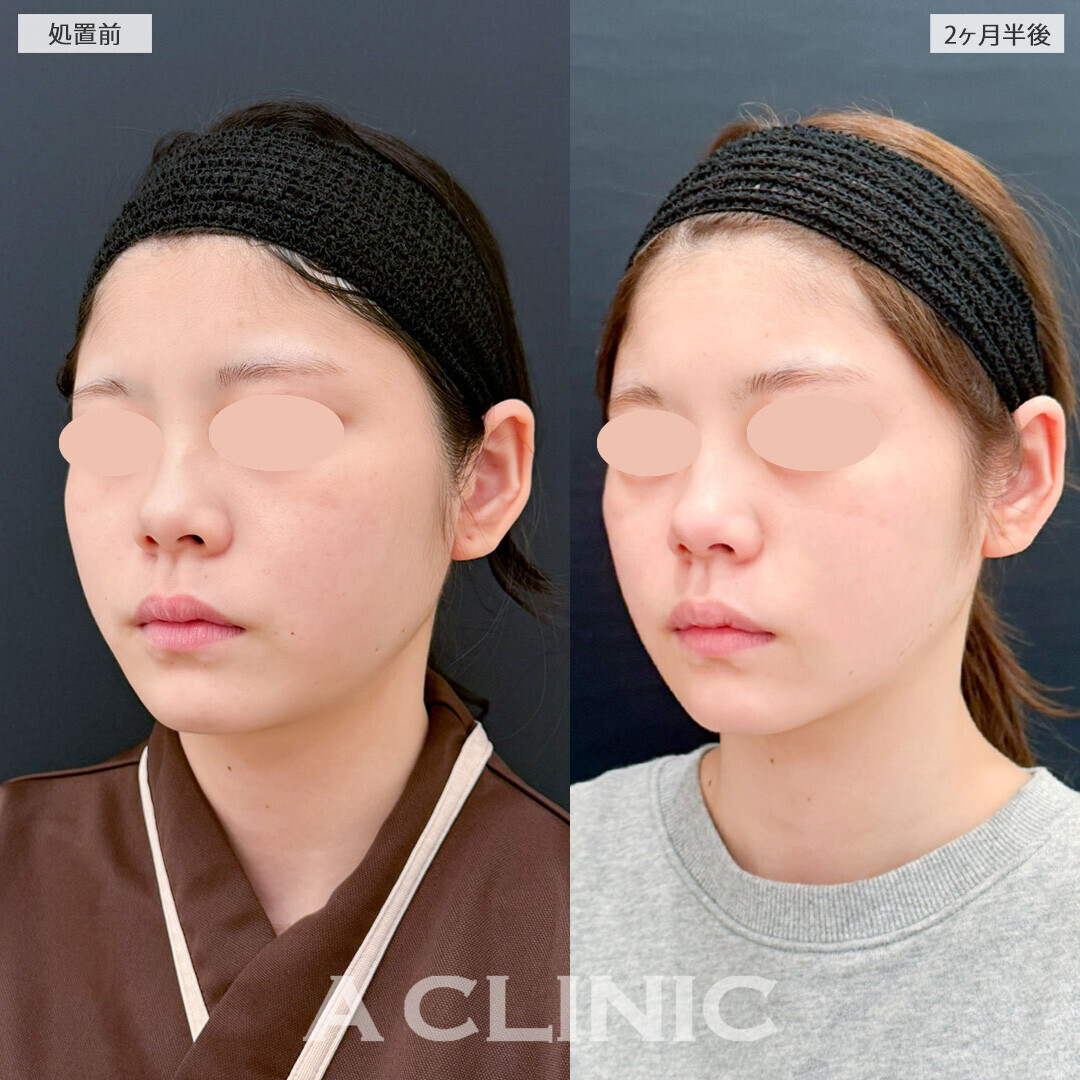 1day小顔脂肪吸引と小顔エラボトックスで整形感なく自然に垢抜け！こちら処置前と2ヶ月半後の症例です(20代女性)