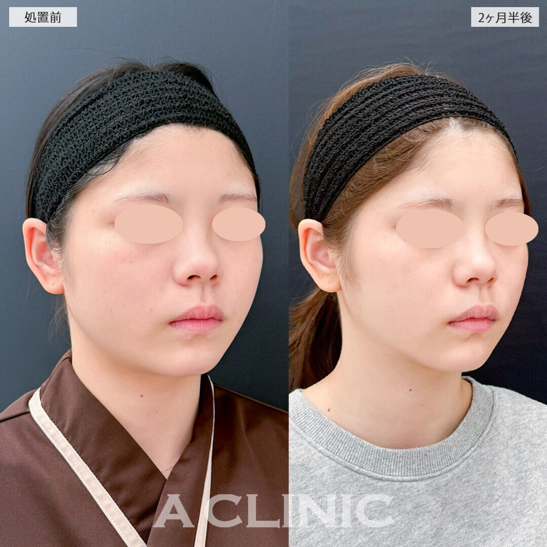 1day小顔脂肪吸引と小顔エラボトックスで整形感なく自然に垢抜け！こちら処置前と2ヶ月半後の症例です(20代女性)