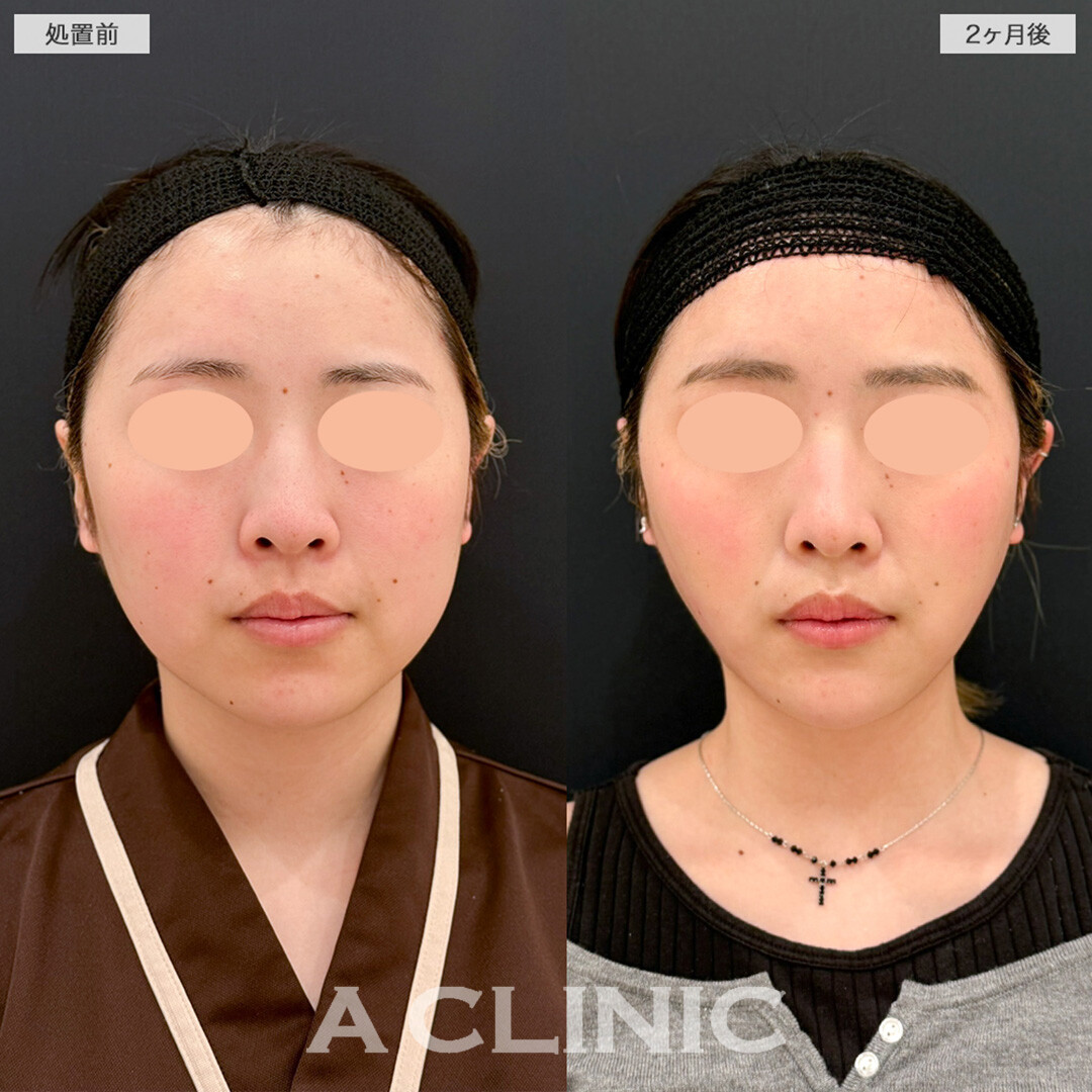 1day小顔脂肪吸引とバッカルファット除去術でより洗練された笑顔へ！こちら処置前と2ヶ月後の症例です(20代女性)