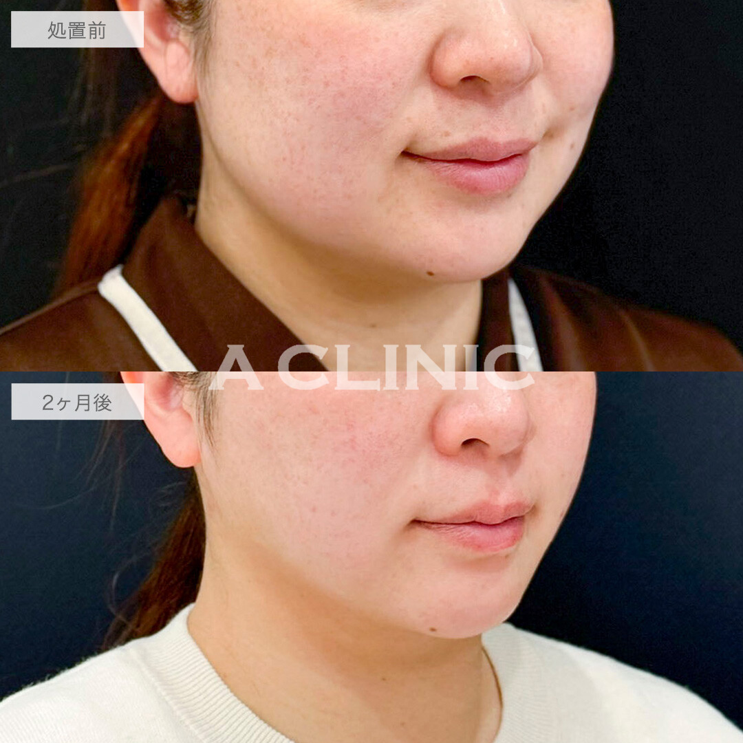 1day小顔脂肪吸引で四角い輪郭からVフェイスへと変化！処置前と2ヶ月後の症例です(40代女性)