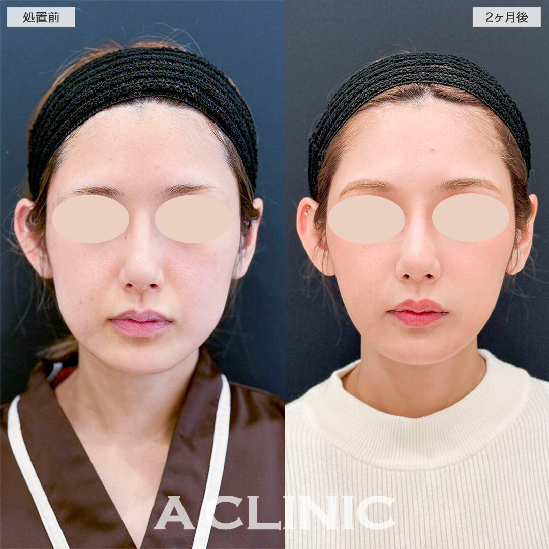 1day小顔脂肪吸引とバッカルファット除去術で笑った時の下膨れ感が無くなりました！処置前と2ヶ月後の症例です(20代女性)