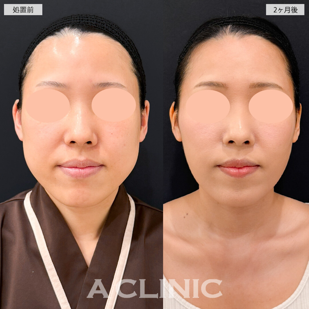 1day小顔脂肪吸引とバッカルファット除去術でダイエット以上の小顔効果を実感できました！処置前と2ヶ月後の症例です(30代女性)