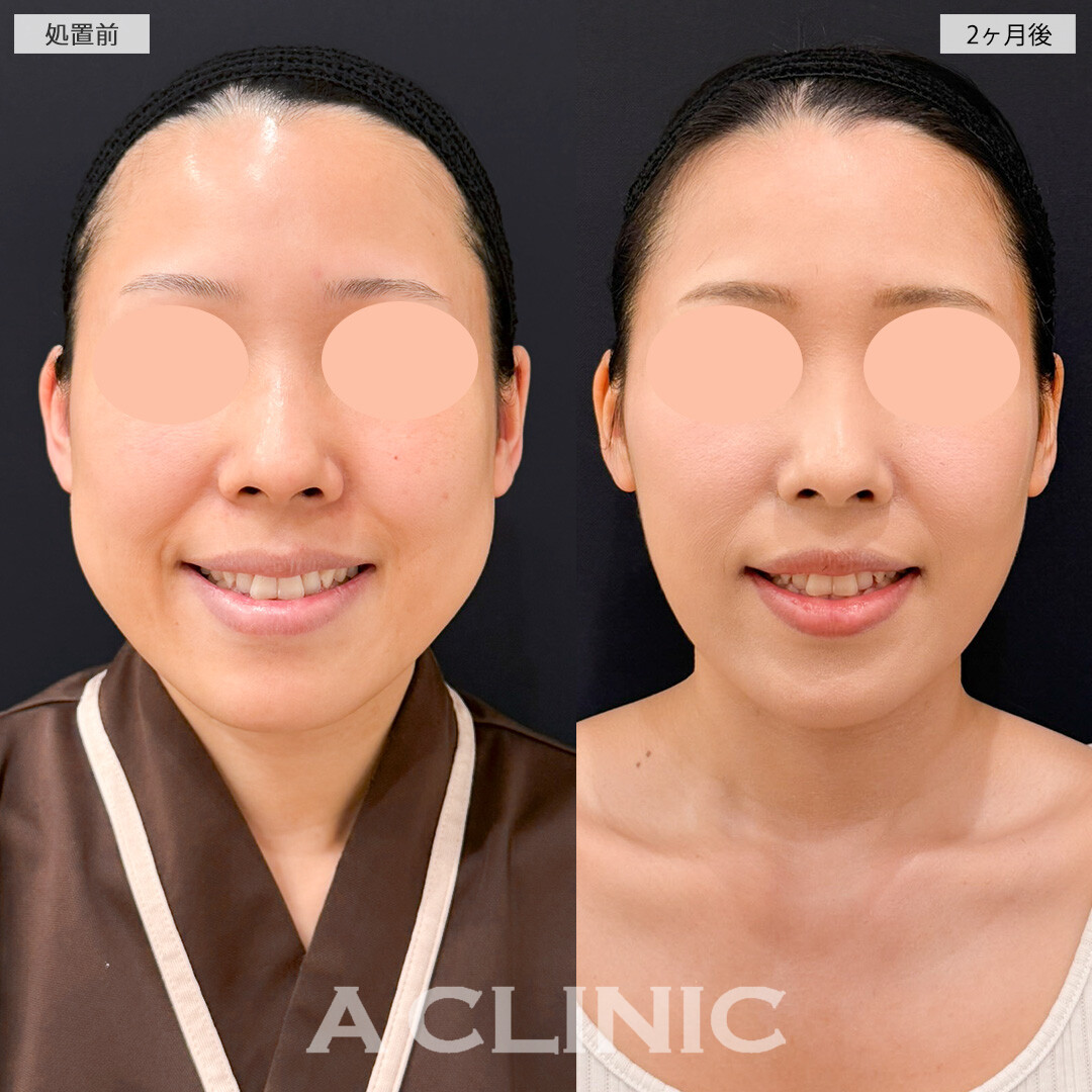 1day小顔脂肪吸引とバッカルファット除去術でダイエット以上の小顔効果を実感できました！処置前と2ヶ月後の症例です(30代女性)