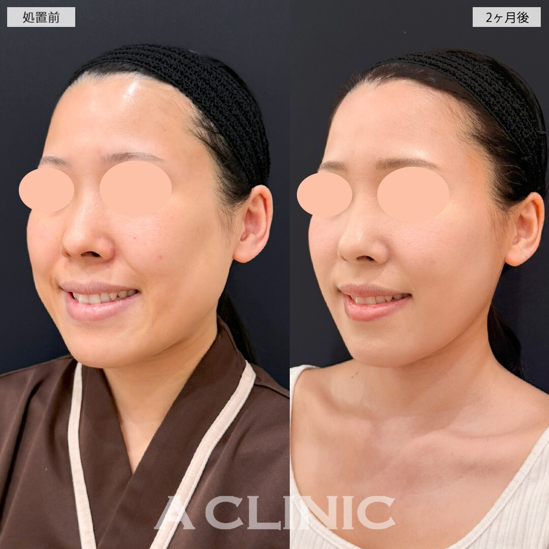 1day小顔脂肪吸引とバッカルファット除去術でダイエット以上の小顔効果を実感できました！処置前と2ヶ月後の症例です(30代女性)