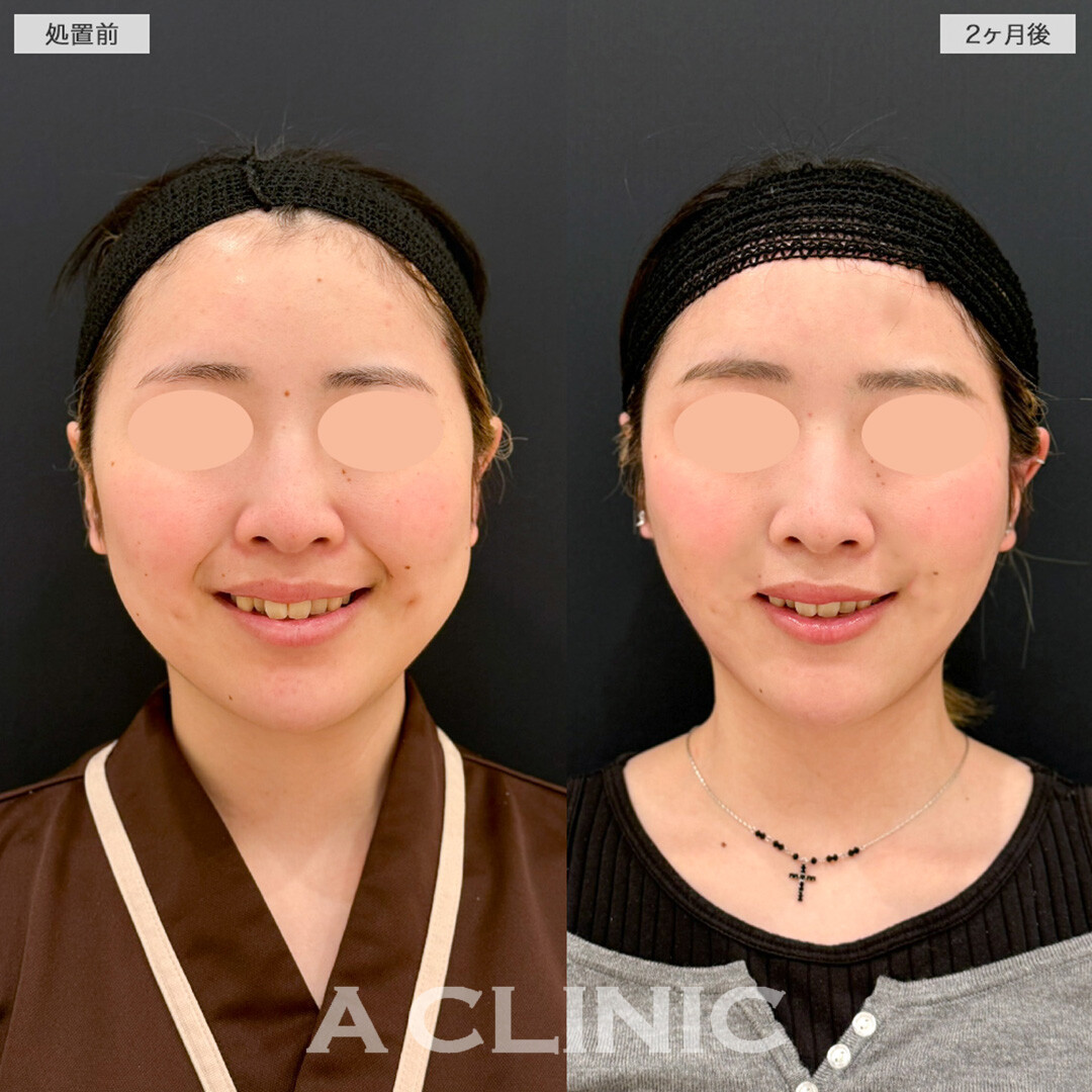 1day小顔脂肪吸引とバッカルファット除去術でより洗練された笑顔へ！こちら処置前と2ヶ月後の症例です(20代女性)