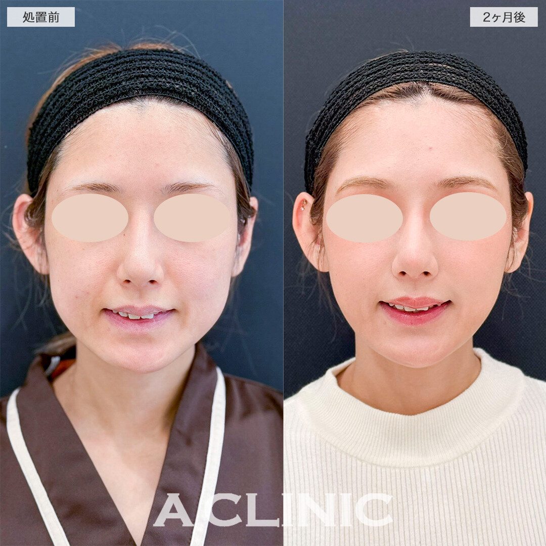 1day小顔脂肪吸引とバッカルファット除去術で笑った時の下膨れ感が無くなりました！処置前と2ヶ月後の症例です(20代女性)