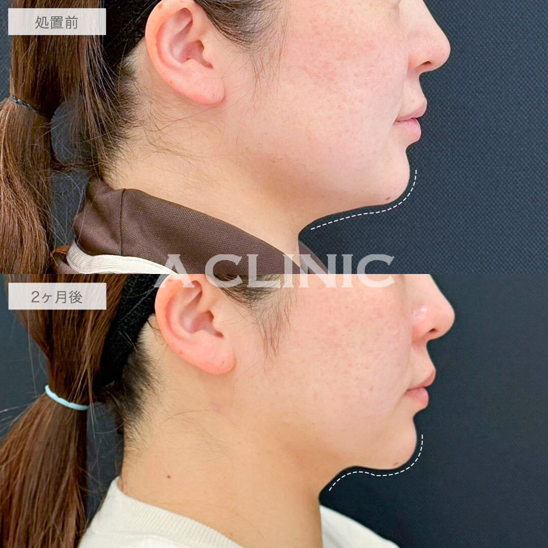 1day小顔脂肪吸引で四角い輪郭からVフェイスへと変化！処置前と2ヶ月後の症例です(40代女性)