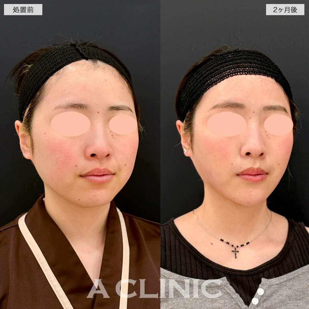 1day小顔脂肪吸引とバッカルファット除去術でより洗練された笑顔へ！こちら処置前と2ヶ月後の症例です(20代女性)