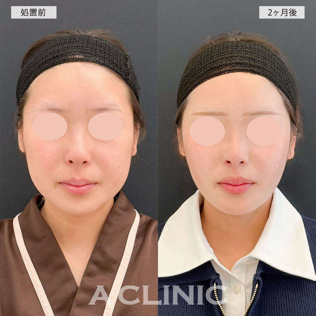1day小顔脂肪吸引とバッカルファット除去術で下膨れ改善！こちら処置前と2ヶ月後の症例です(20代女性)