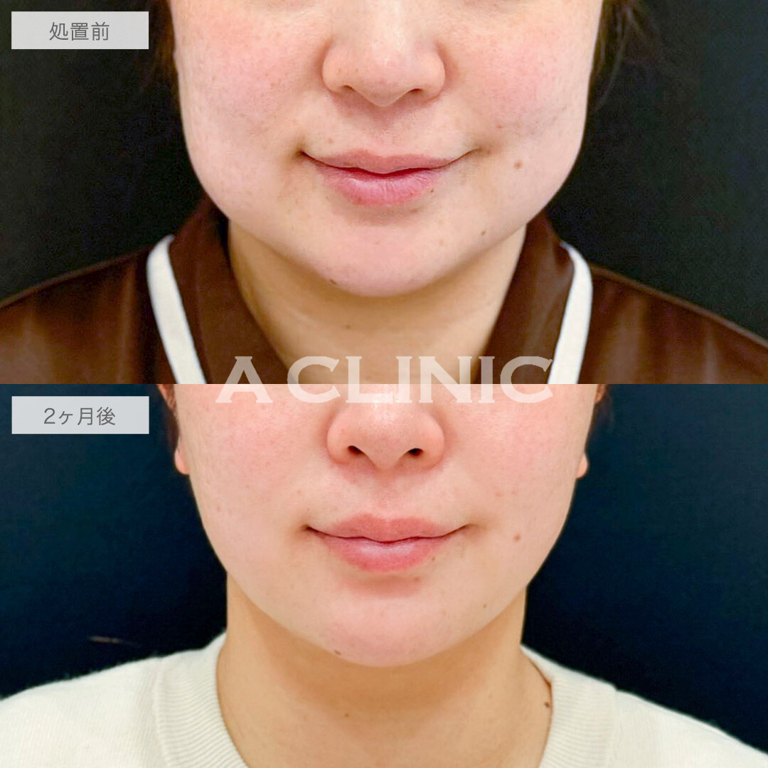 1day小顔脂肪吸引で四角い輪郭からVフェイスへと変化！処置前と2ヶ月後の症例です(40代女性)