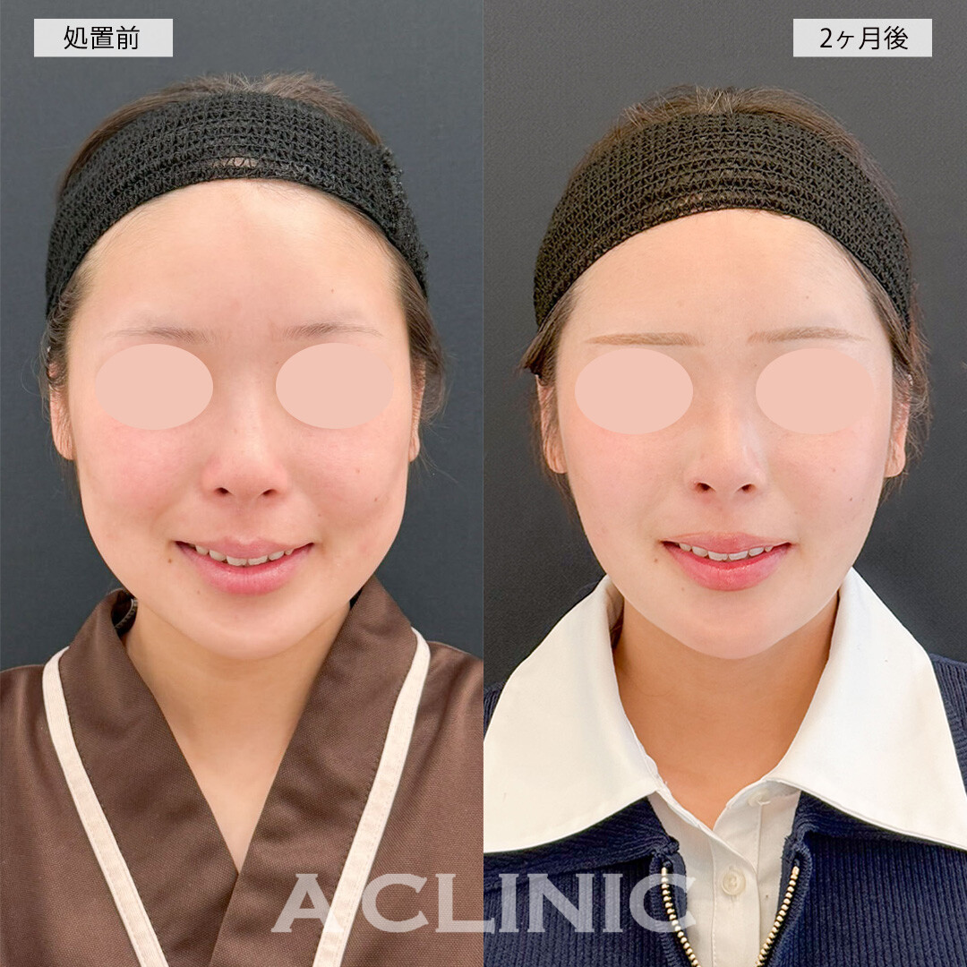 1day小顔脂肪吸引とバッカルファット除去術で下膨れ改善！こちら処置前と2ヶ月後の症例です(20代女性)