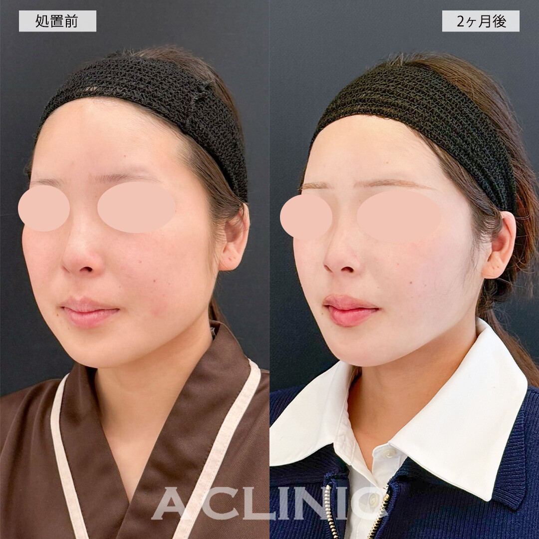 1day小顔脂肪吸引とバッカルファット除去術で下膨れ改善！こちら処置前と2ヶ月後の症例です(20代女性)