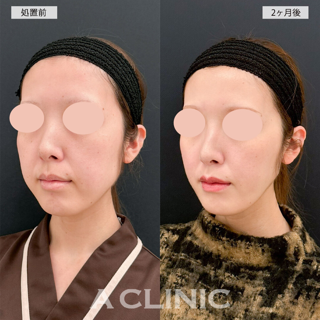 1day小顔脂肪吸引で余分な顔の余白が解消されました！こちら処置前と2ヶ月後の症例です(20代女性)