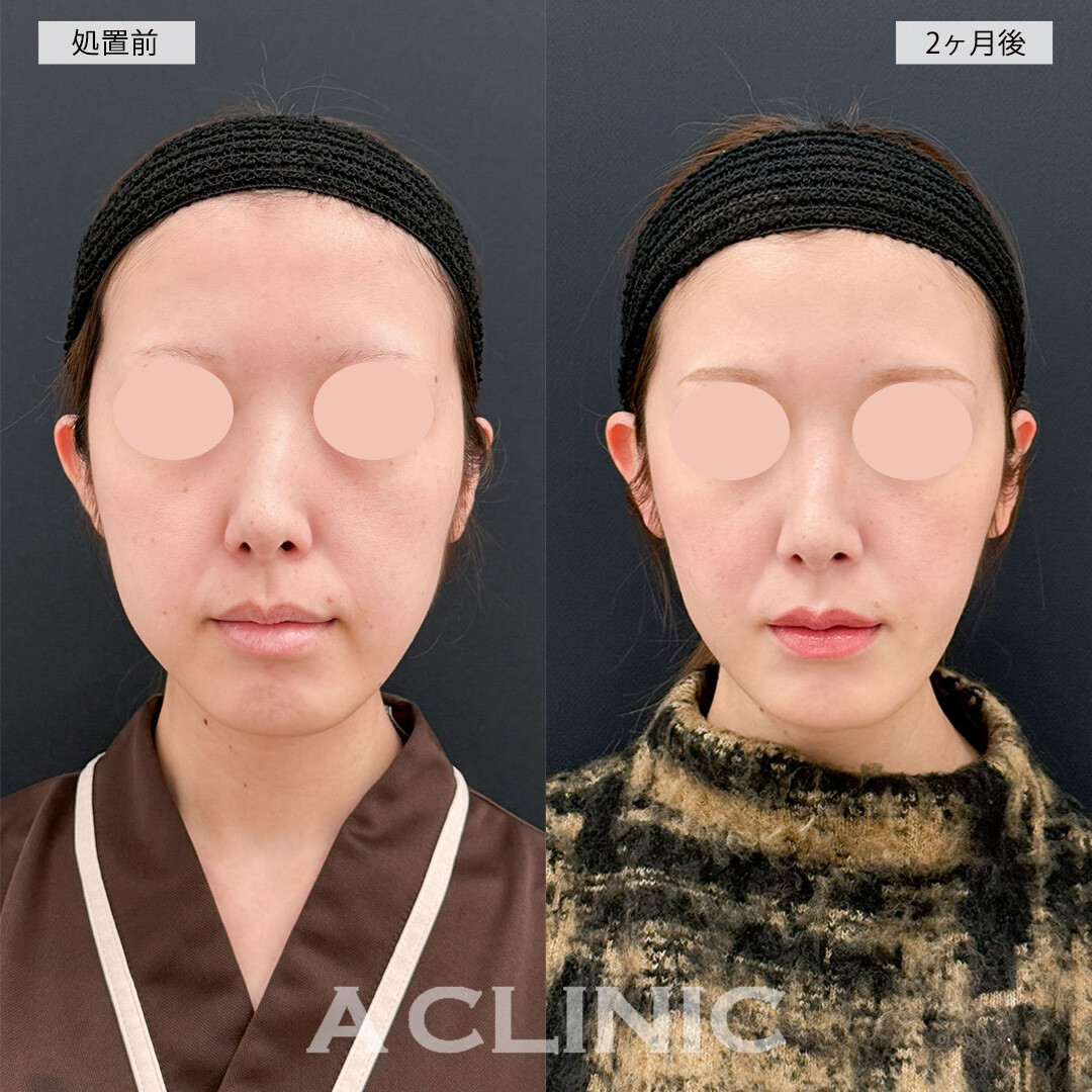 1day小顔脂肪吸引で余分な顔の余白が解消されました！こちら処置前と2ヶ月後の症例です(20代女性)